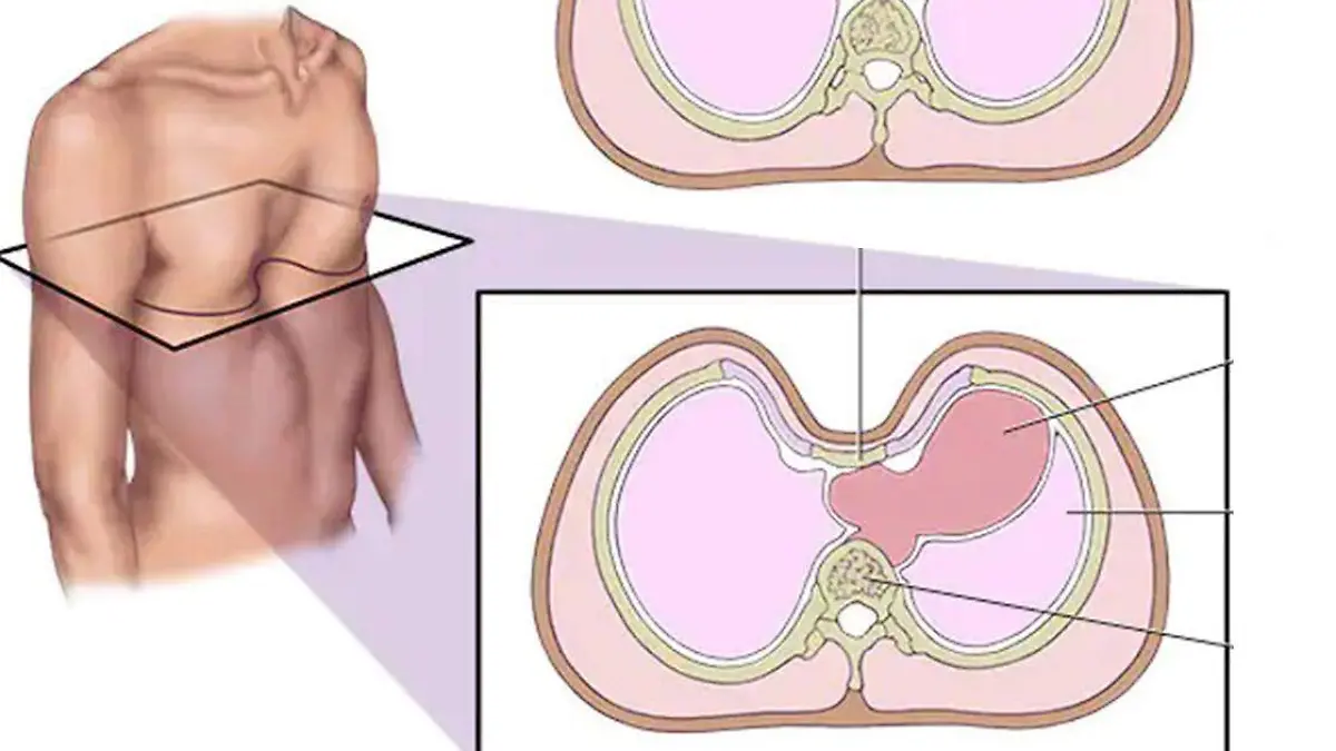 Esta condición también conocida como tórax excavado o 'pectus excavatum', es una afección que suele ser más común en niños